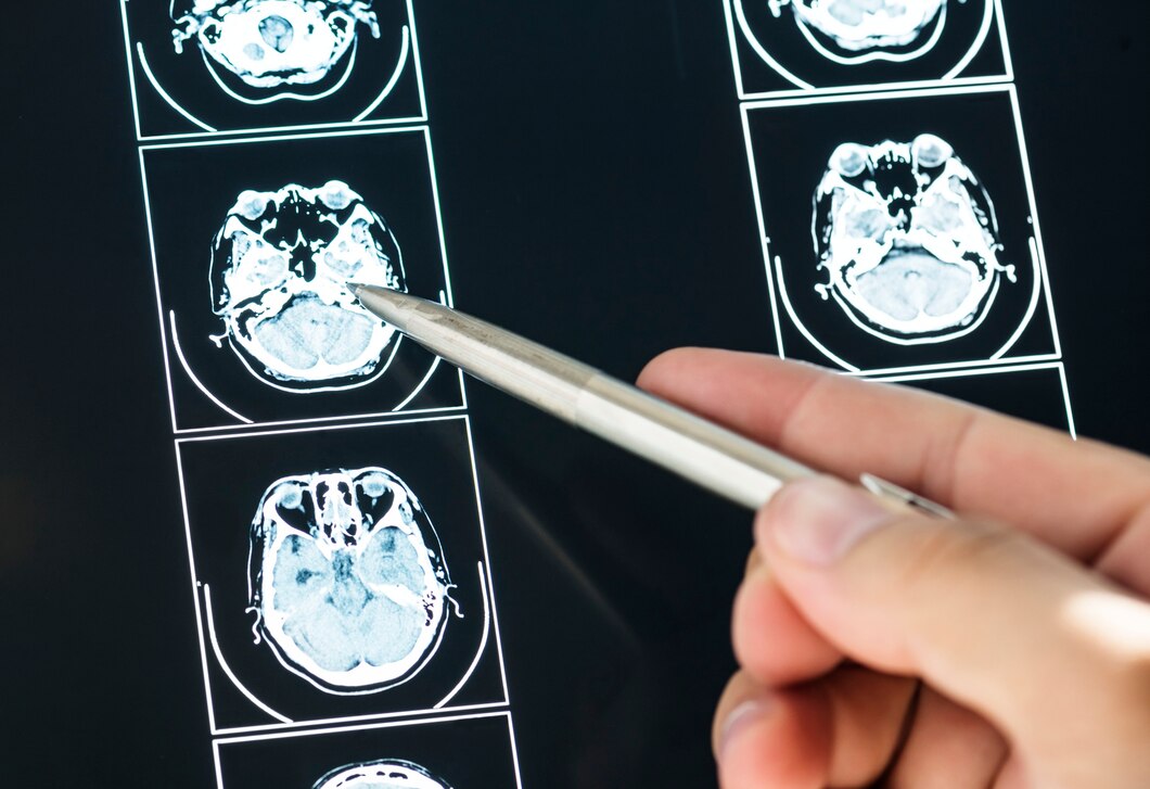 Jakie Są Najczęstsze Choroby Neurologiczne I Jak Je Rozpoznawać Gamisforyou 2770